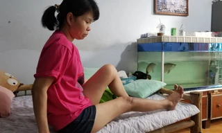 Chị Trương Thị Thu Nguyệt và thương tật ở chân