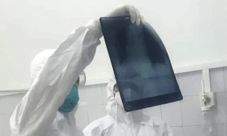 Kiểm tra phim chụp Xquang phổi cho bệnh nhân mắc COVID-19. Ảnh: TS -BS Lương Quốc Chính