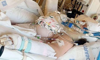 Destini Crane bị bỏng nặng sau khi bắt chước một trào lưu trên TikTok.