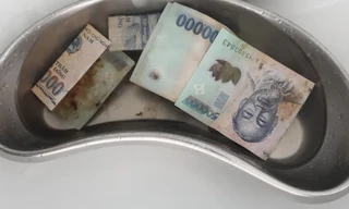 Hy hữu: Mâu thuẫn gia đình, người phụ nữ nuốt 12,5 triệu đồng vào bụng