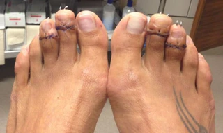 Chân của Paulina sau khi được phẫu thuật cưa ngắn