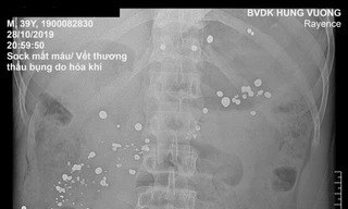 Ảnh chụp X quang bệnh nhân có nhiều dị vật kim khí cản quang trong ổ bụng.