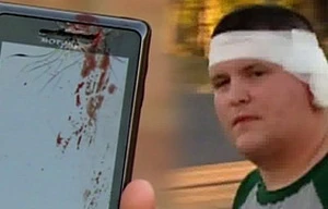 Điện thoại phát nổ gây chấn thương nặng