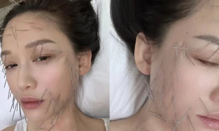 Trần Kiều Ân gây tranh cãi với phương pháp làm đẹp đau đớn