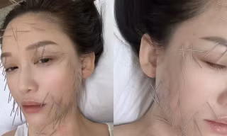 Trần Kiều Ân gây tranh cãi với phương pháp làm đẹp đau đớn