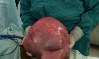 Cắt u xơ khổng lồ nặng gần 10kg