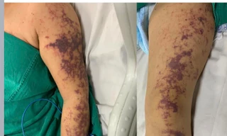 Điện Biên: Một người tử vong sau khi ăn tiết canh lợn 