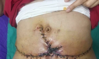 Hoại tử nặng vì hút mỡ bụng giảm béo