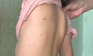 Xuất hiện ổ dịch thủy đậu tại trường mầm non