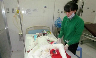 Cháu Thủy đang nguy kịch vì bị cháy toàn thân
