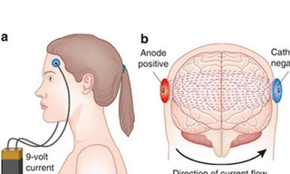 Kích điện não để thông minh hơn