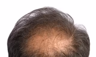 Kích thích nang tóc để chữa hói đầu