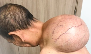 Phẫu thuật cắt bỏ thành công khối u 'khổng lồ' trên lưng cụ bà 95 tuổi