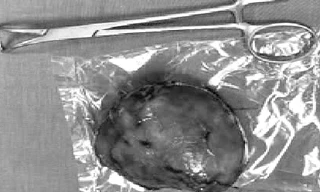 Bình Định: Phẫu thuật thành công khối bướu 'khủng' cho cụ bà 81 tuổi