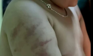 Vụ gia đình tố cô giáo đánh trẻ ở Bình Định: Phòng Giáo dục báo cáo gì?