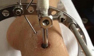 Hãi hùng với cảnh bắt vít để kéo dài chân