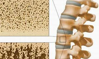 Loãng xương "kẻ ăn cắp” giấu mặt
