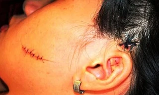 Dùng dao lam rạch mặt vợ vì mâu thuẫn tình cảm