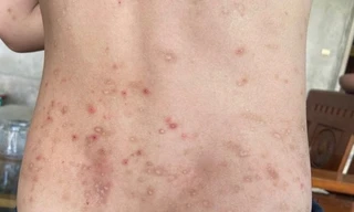 Hàng trăm người ở Hà Tĩnh bị côn trùng đốt gây sẩn ngứa