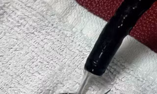 Lưỡi câu dài gần 4cm mắc trong thực quản của cụ ông 83 tuổi