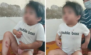 Bác sĩ báo công an sau khi bé 4 tuổi nhập viện với nhiều vết thương đáng ngờ