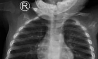 Ruột non bệnh nhi thủng 5 lỗ vì món đồ chơi nguy hiểm