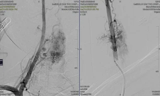 Nam thanh niên liệt suốt 13 năm sau cú ngã vì căn bệnh hiếm gặp