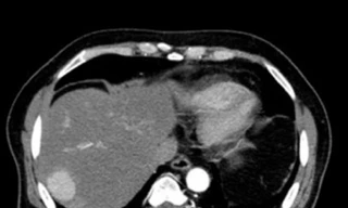 Phát hiện 'sát thủ' ung thư gan khi đi khám tim mạch