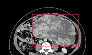 Người phụ nữ mang khối u nặng 3,5kg trong ổ bụng 