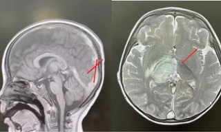 Bé trai hơn 2 tuổi đột quỵ vì bệnh lý hiếm gặp