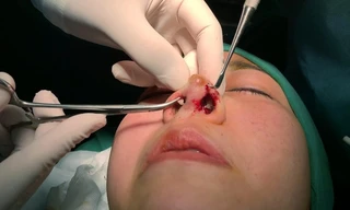 Nâng mũi trong khách sạn, 2 phụ nữ bị tai biến và trộm cắp tài sản