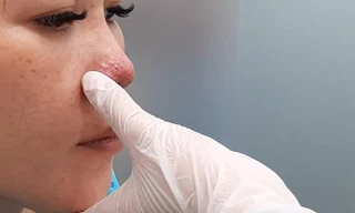 Mũi miệng bầm tím, mặt biến dạng sau tiêm chất làm đầy tại spa