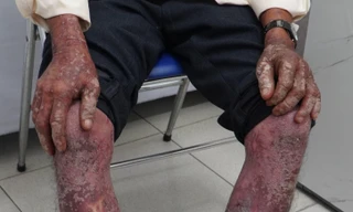 Người đàn ông bong da toàn thân, nhiễm độc nặng vì thuốc diệt cỏ