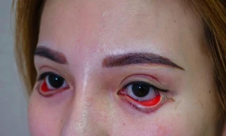 Cắt mí thành 'đôi mắt quỷ', cô gái trẻ bị cho thôi việc