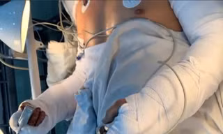 Nam công nhân bị đứt lìa cả 2 cẳng tay vì đồng nghiệp... sơ ý