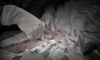 Xử lý cứu bệnh nhân tia xạ trị ung thư khiến cơ thể bị loét suốt 10 năm 