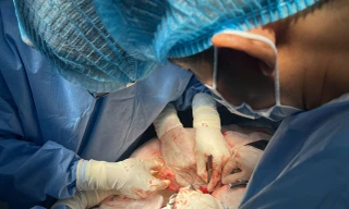 Cảnh báo tử vong vì vỡ túi phình động mạch chủ bụng