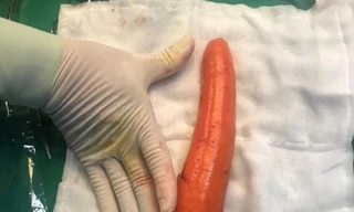 Đưa củ cà rốt dài 20 cm vào 'chỗ kín', thiếu niên phải nhập viện