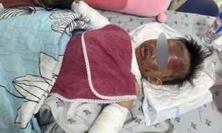 Bình gas phát nổ, bé gái bị bỏng nặng