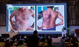 Những dấu hiệu trên da cảnh báo bệnh lý ác tính