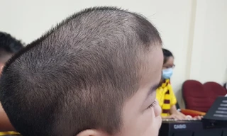 Khoảng 6 triệu người Việt Nam đang mắc bệnh hiếm