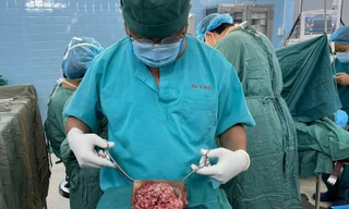 Đắp lá điều trị, người phụ nữ mang khối ung thư đến 30 cm ở 'vùng kín' 