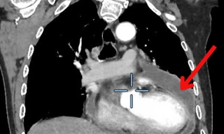 Cụ ông mắc lao màng ngoài tim suýt tử vong vì tưởng bị cảm sốt thông thường