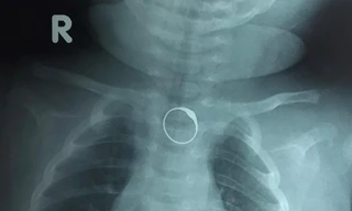 Chiếc nhẫn vàng kẹt ở thực quản bé gái 2 tháng tuổi