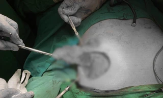 Tan nát 'vòng 1' sau nâng ngực làm đẹp