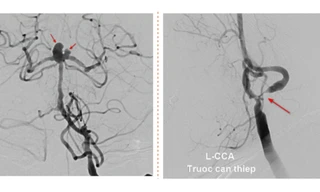 Người phụ nữ bị cùng lúc 2 dạng đột quỵ đặc biệt nguy hiểm
