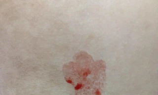 Bé gái 10 tuổi đột nhiên đổ mồ hôi máu