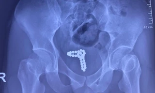 Nam thanh niên gặp nạn vì dùng chuỗi bi kim loại 'tự sướng'