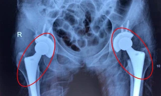 Nhiều người trẻ bị mục xương vì chất kích thích ai cũng dùng