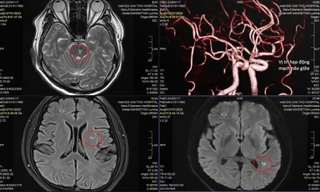 Doanh nhân trẻ đột quỵ vì thường xuyên tiếp đối tác bằng rượu bia